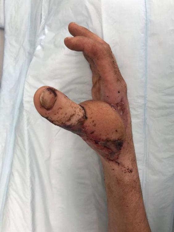 Jempol tangan Zac diganti dengan jempol kaki