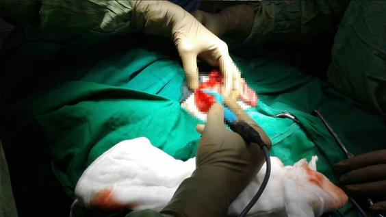 Proses operasi pengangkatan janin dalam tubuh bayi