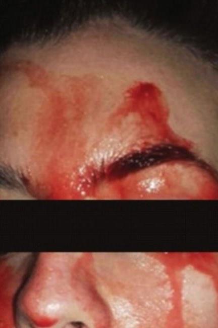 Woman Sweats Blood From Face baffles Doctors