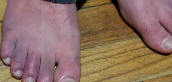 I Thought I D Misheard My Doctor When She Asked If I Had Covid Toes But This Weird New Coronavirus Symptom Is Real The Independent The Independent