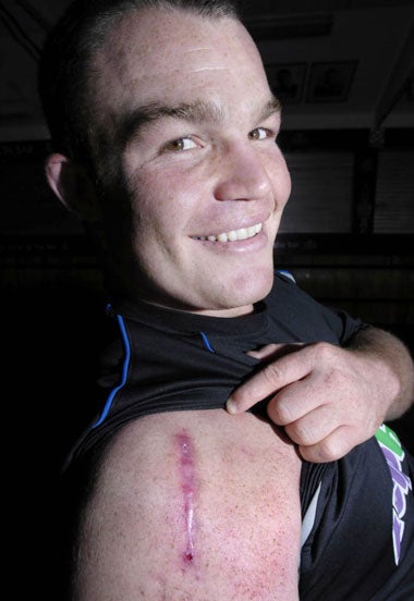 The England and Bath prop, Matt Stevens, shows his scarred shoulder after repair surgery