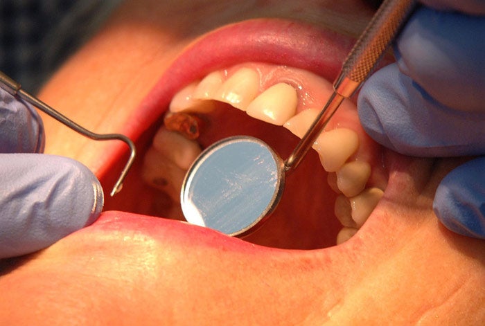 Nearly a third of Britons have not visited the dentist in the past two years over cost concerns
