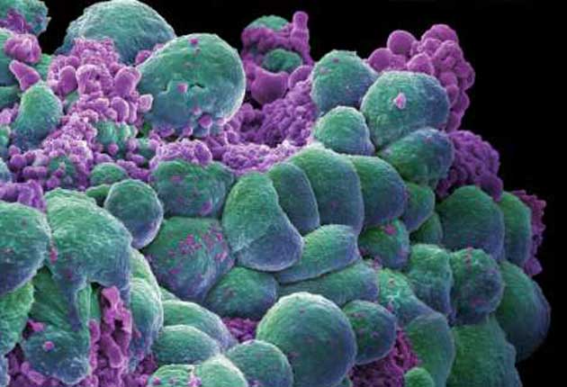 Could cancer (such as the breast cancer cells shown here) be down to bad luck?