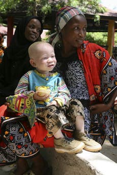 Malawi police told to 'shoot' criminals attacking albinos for body