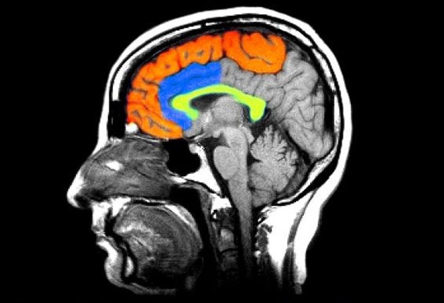 A colour enhanced MRI image of the brain shows one of the theories into what may be the chemical basis for Schizophrenia. Researchers have found reduced receptors for dopamine in the brain (areas colourized)