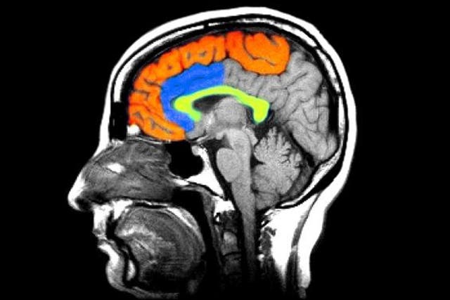 A colour enhanced MRI image of the brain shows one of the theories into what may be the chemical basis for Schizophrenia. Researchers have found reduced receptors for dopamine in the brain (areas colourized)