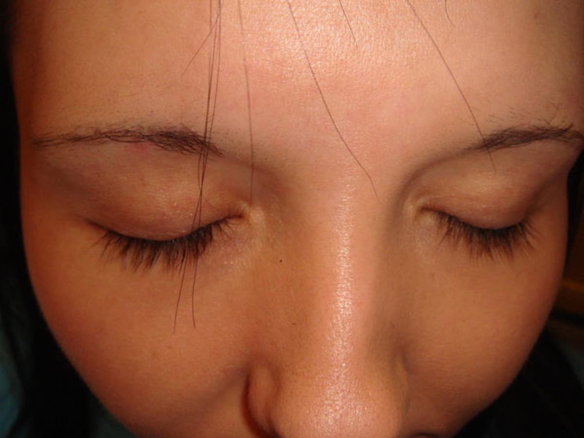 Surgical team claims UK's first eyelash transplant | The Independent | The  Independent