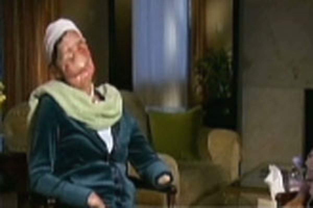 Woman attacked by chimp reveals face on Oprah | The Independent | The ...
