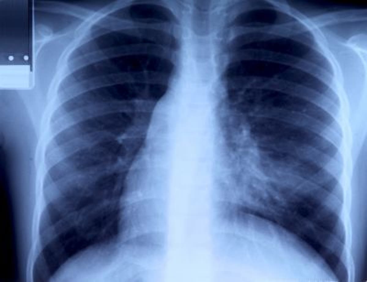 Lung cancer: New drug shows promise in lab mice | The Independent | The ...