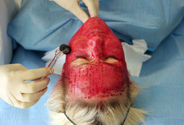 <p>Platelet facial rejunvenation, or the vampire facial, is a popular alternative to surgery</p>