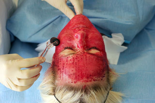 <p>Platelet facial rejunvenation, or the vampire facial, is a popular alternative to surgery</p>