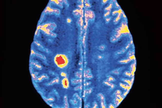 La esclerosis múltiple, una enfermedad crónica, puede tardar 40 años en seguir su curso. Al desarrollar medicamentos para retrasar su progresión, los médicos han utilizado escáneres cerebrales para mostrar lesiones.