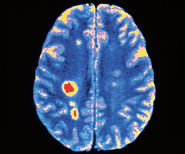 <p>La esclerosis múltiple, una enfermedad crónica, puede tardar 40 años en seguir su curso. Al desarrollar medicamentos para retrasar su progresión, los médicos han utilizado escáneres cerebrales para mostrar lesiones.</p>