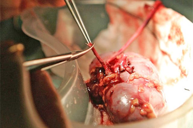 Scientists are beginning to close in on pioneering transplants of synthetic kidneys