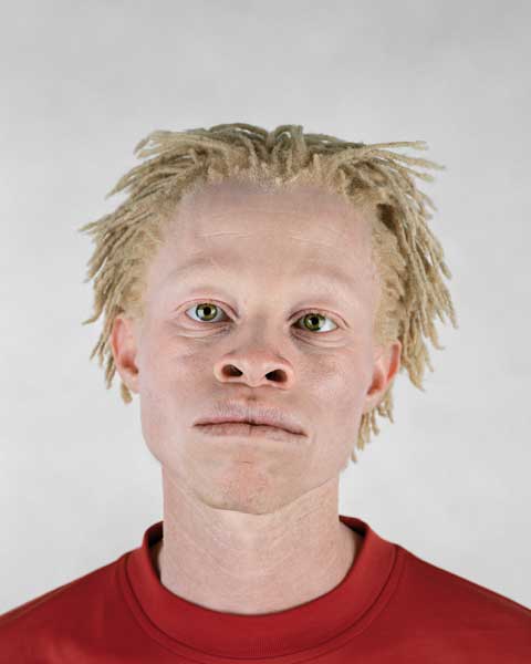 Albinism is a condition that effects around one in 20,000 people. However rates are much higher in sub-Saharan Africa