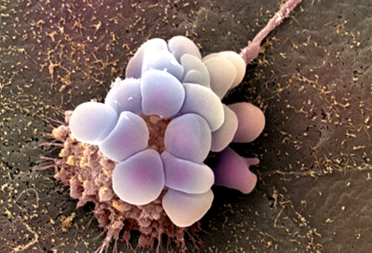simple-blood-test-could-save-hundreds-from-ovarian-cancer-the