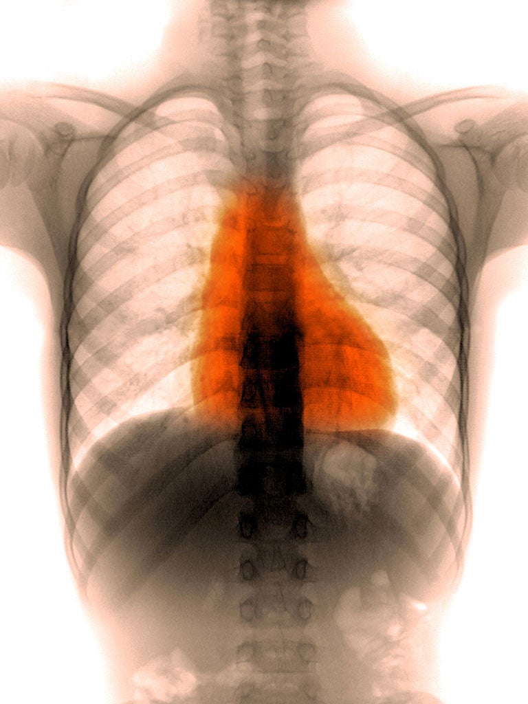 An X-ray of a healthy eight month-old's chest