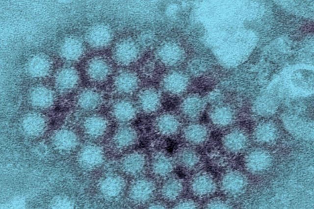 Norovirus the food poisoning bug that causes violent stomach flu