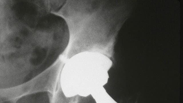 Hip implants have traditionally not had to pass any clinical trials before being used in patients