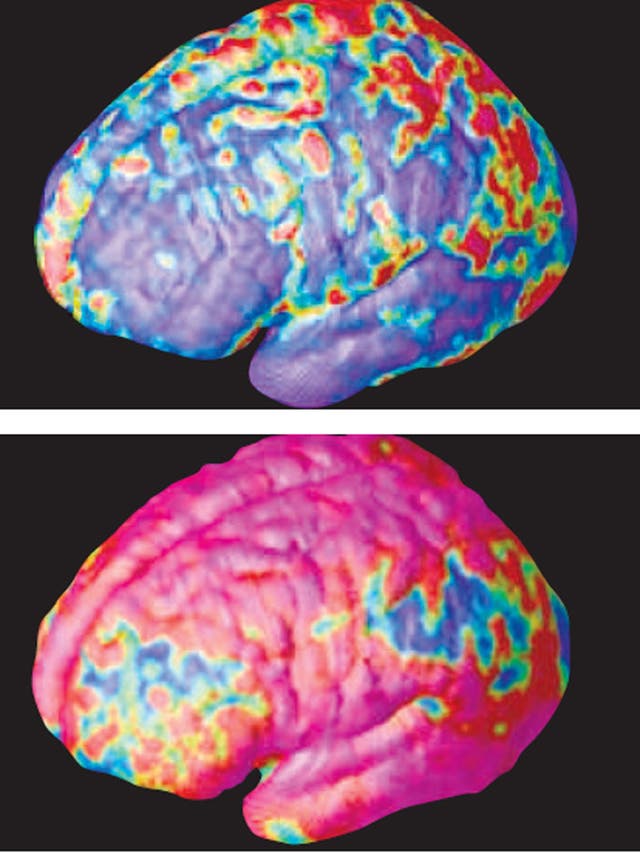 The brain of a person shortly after diagnosis with schizophrenia (top) showing it relatively unscathed. Five years later, there is substantial loss of grey matter (above). Damage starts in the outer regions of the brain and spreads to all parts over the y