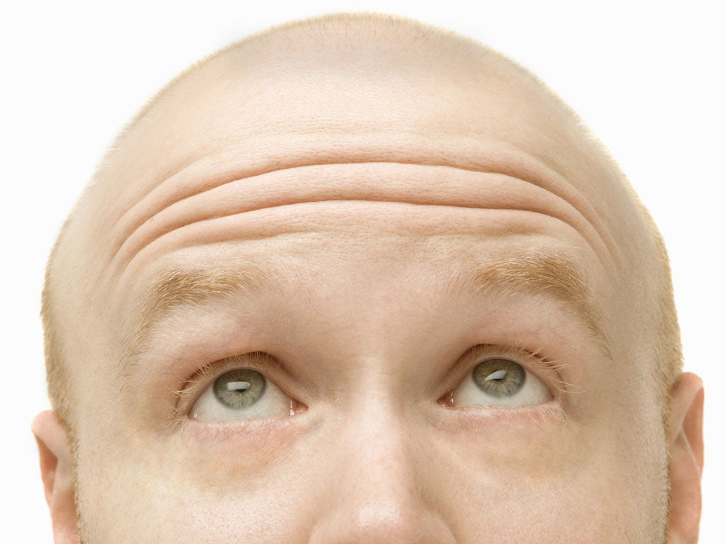 Scientists have discovered that the protein PGD2 is linked to baldness