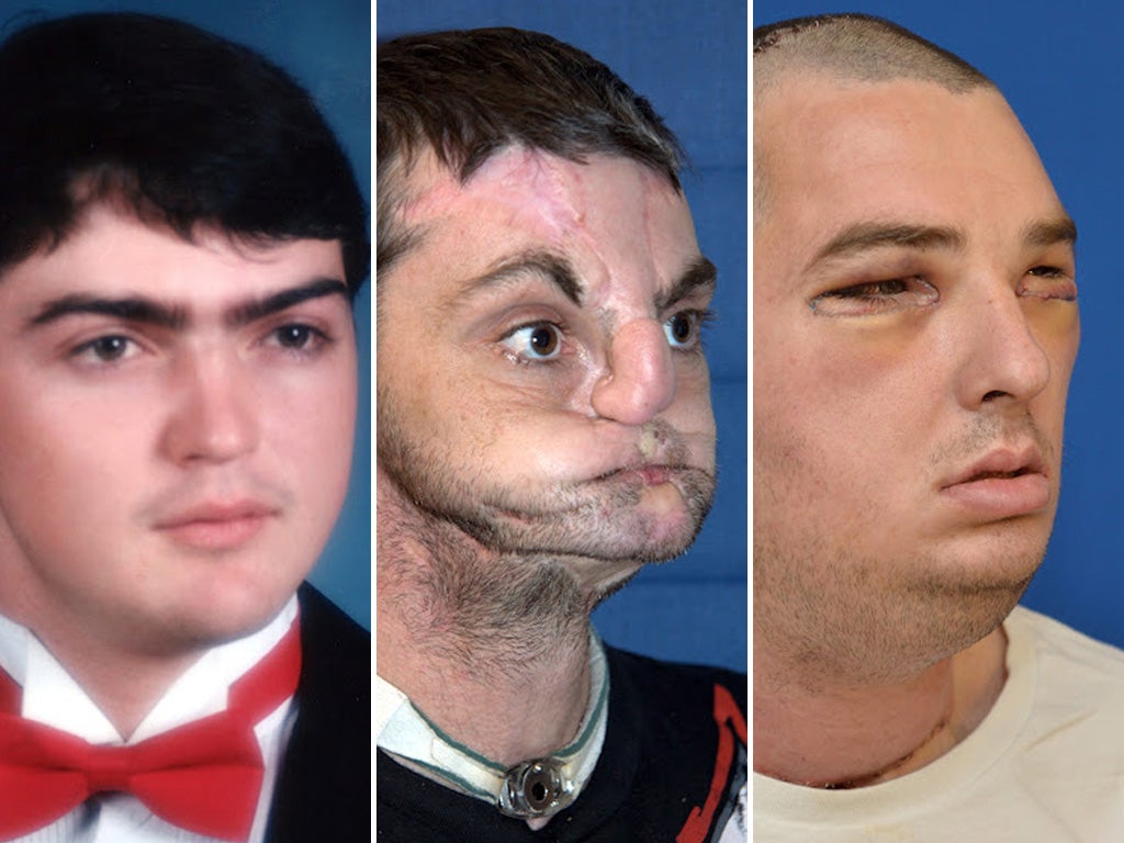 These photographs released by the University of Maryland Medical Center show images of full face transplant recipient 37-year-old Richard Lee Norris of Hillsville, Virginia