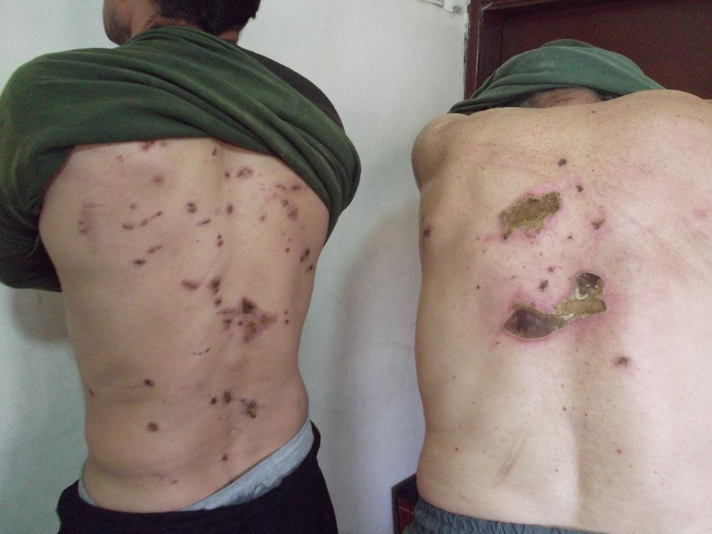 Yousef and Ahmed display the injuries they suffered at the hands of President Assad’s forces
