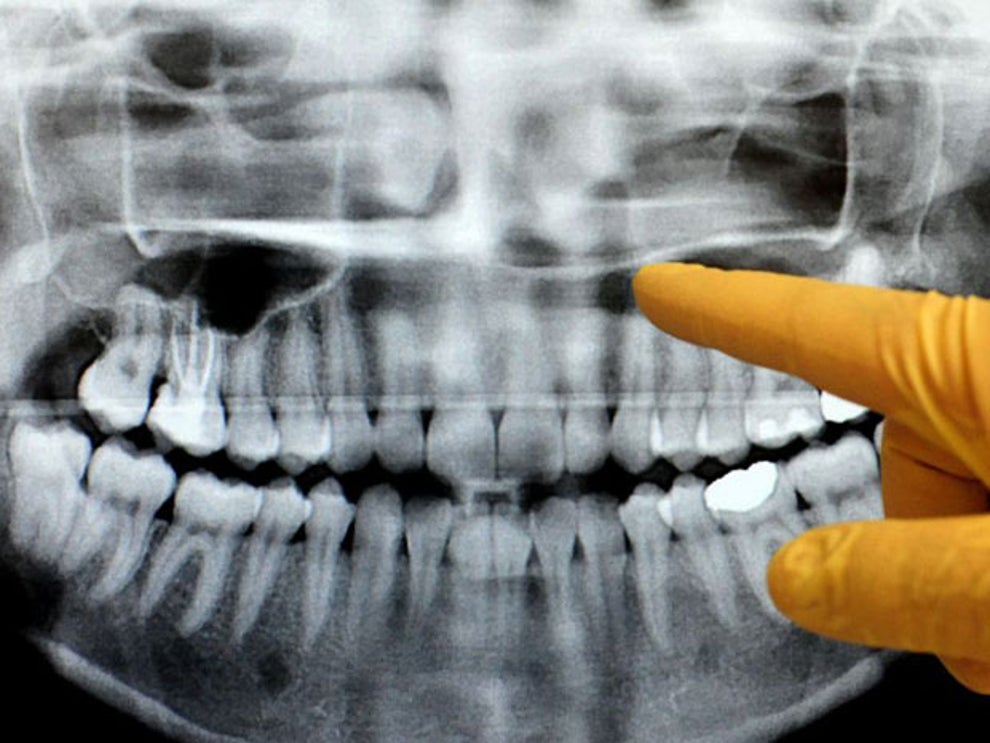 Researchers link dental xrays to brain tumours The Independent The
