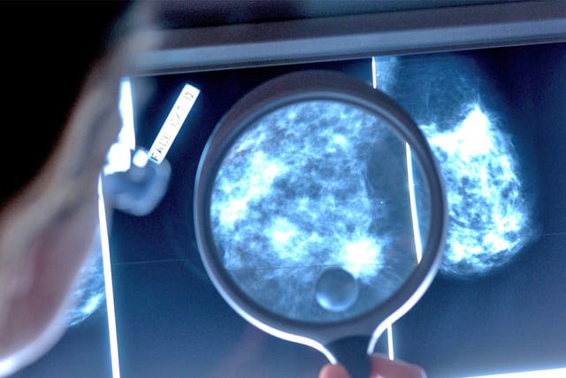 A doctor examines a mammograph of a breast cancer patient