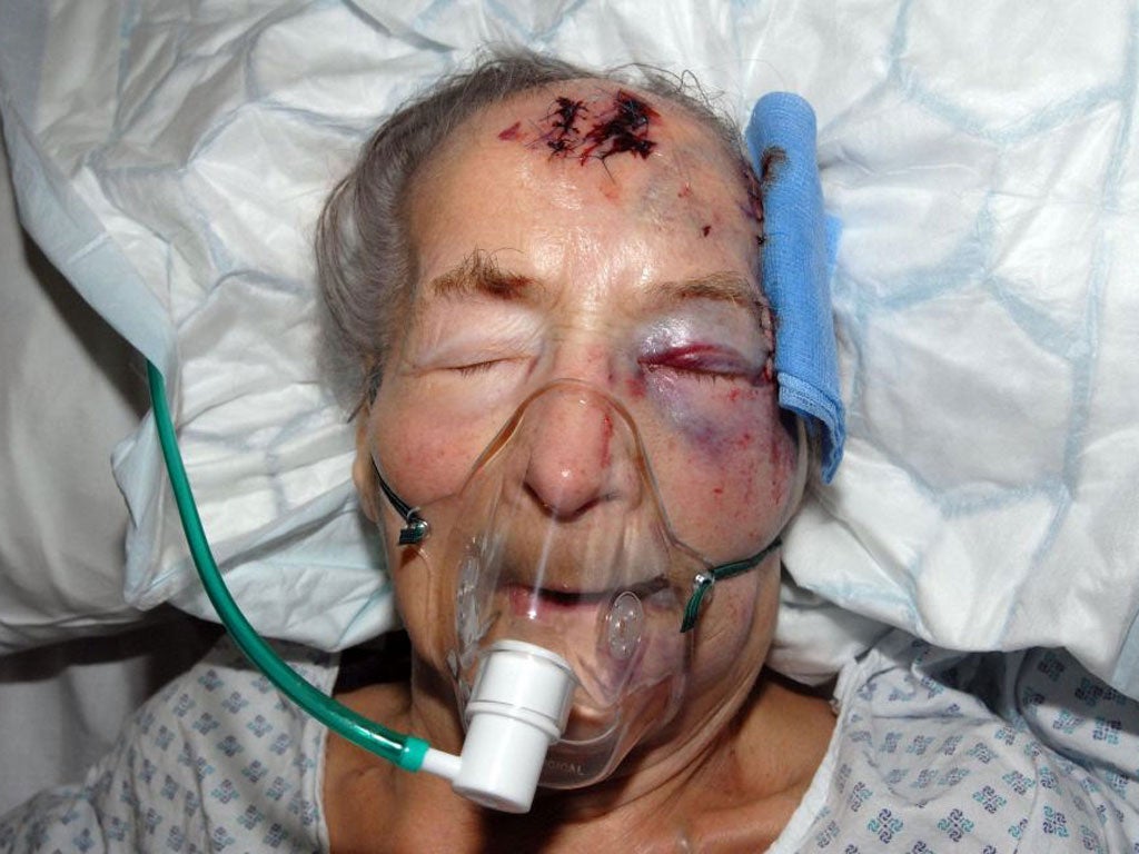 94-year-old Emma Winnall suffered multiple injuries including a fractured skull, a broken arm and wrist, and a partially severed finger in the attack