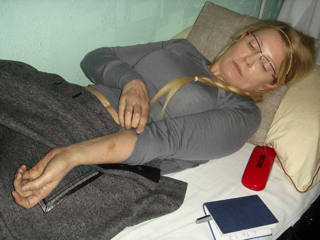 Yulia Tymoshenko, who is on hunger strike and has spinal problems, shows her bruises