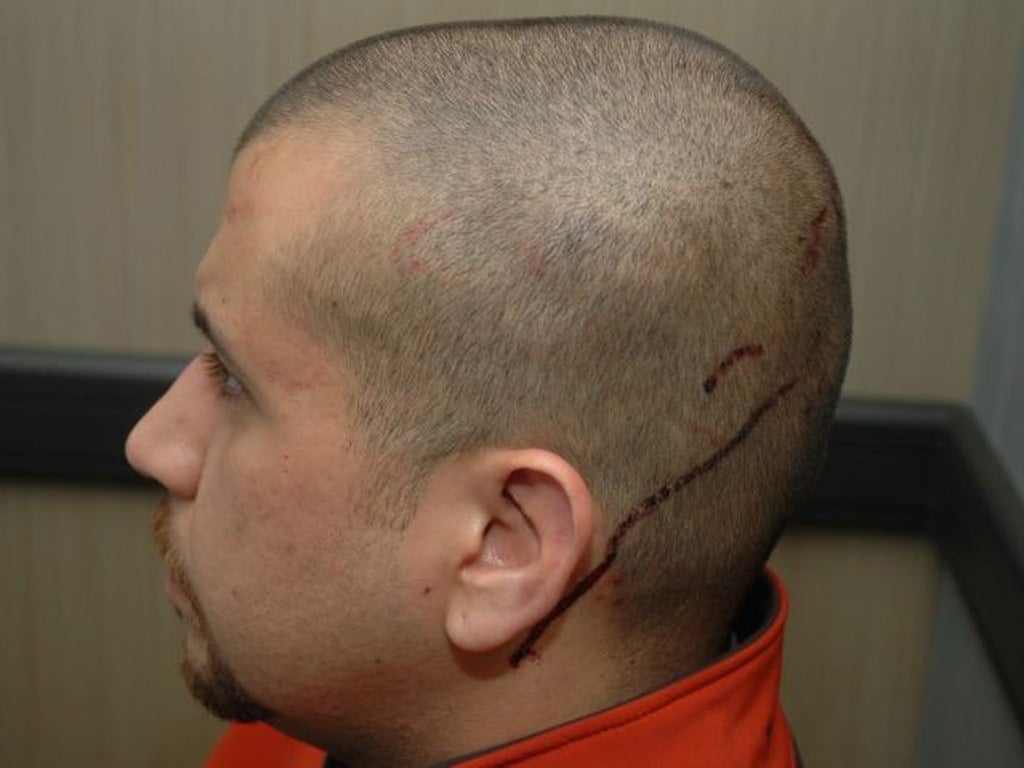 Newly released photographs show the injuries suffered by Trayvon
Martin’s killer George Zimmerman
