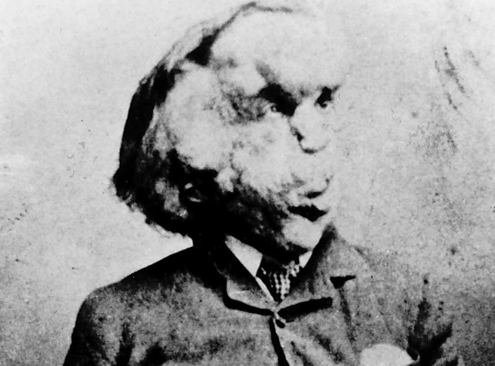 In the bones: Joseph Merrick, photographed about 1889. His skeleton will be tapped for DNA
