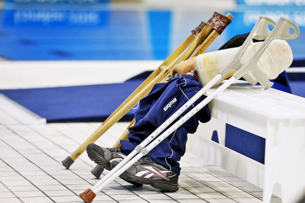 The new technology for prosthetic legs that could reduce NHS waiting lists by 50%