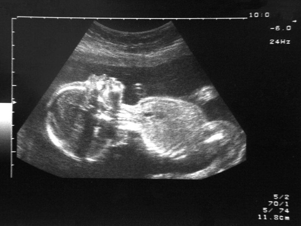 A foetus at 20 weeks (ultrasound scan)