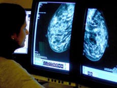 Hunt admits 450,000 women missed out on breast cancer screening