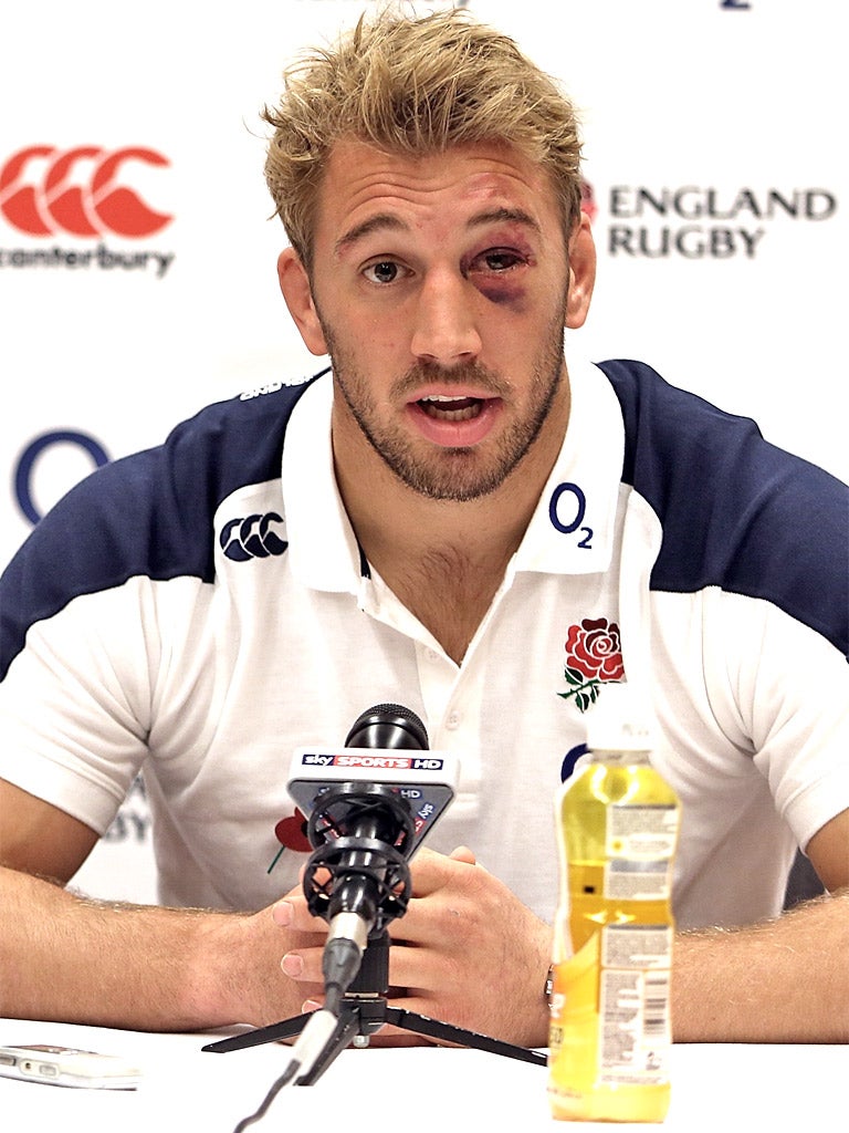 Chris Robshaw, the England captain, shows the media his shiner yesterday