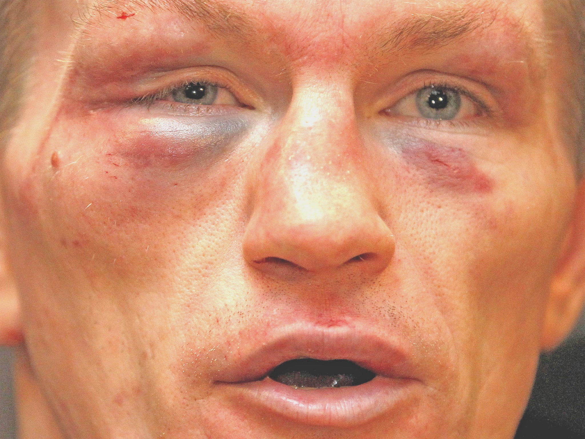 Scars of battle still fresh, Hatton announces his retirement