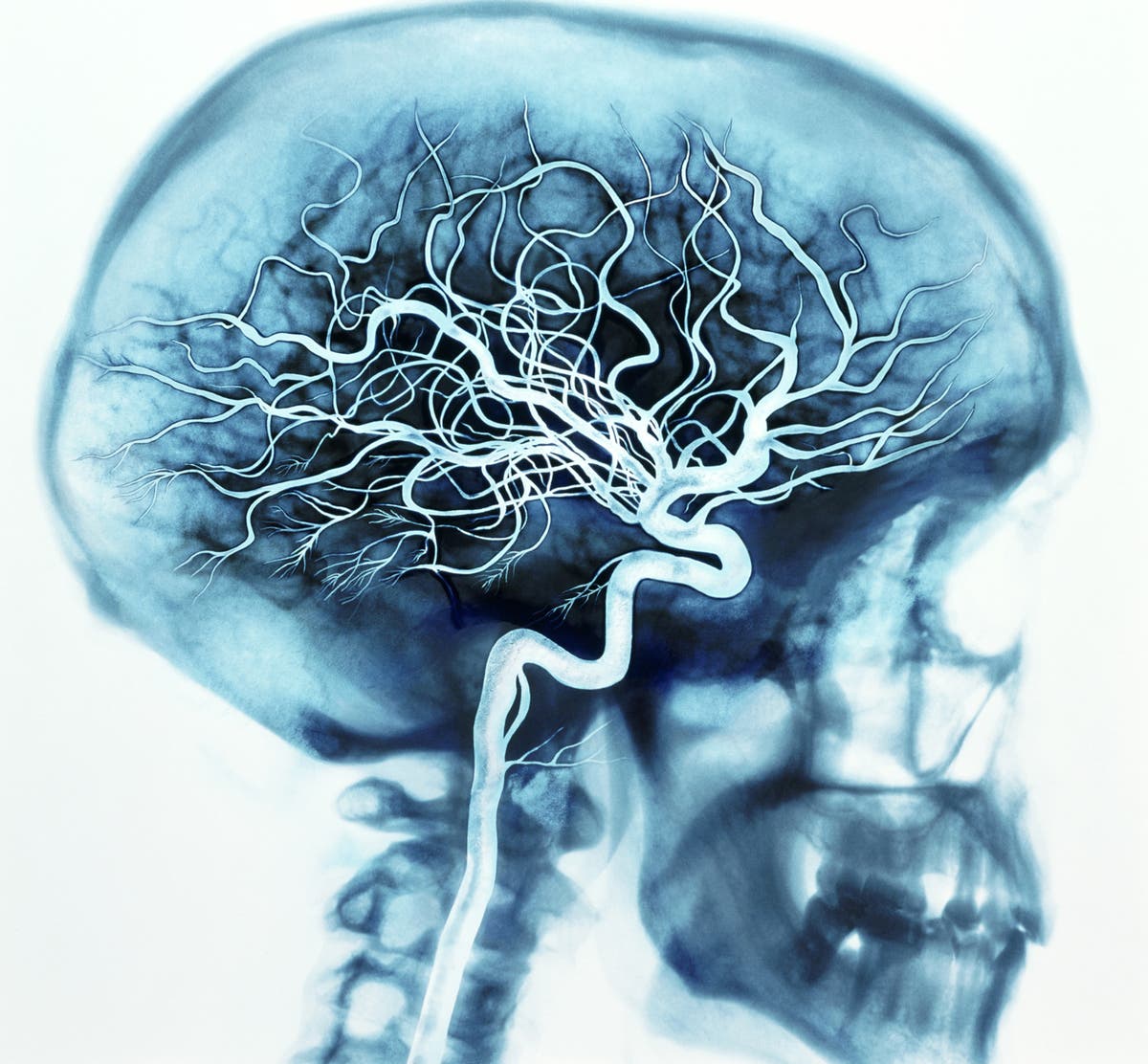 Заболевания сосудов головы. Ангиография головного мозга. Магнитно-резонансная ангиография. Ангиография сосудов головного мозга.