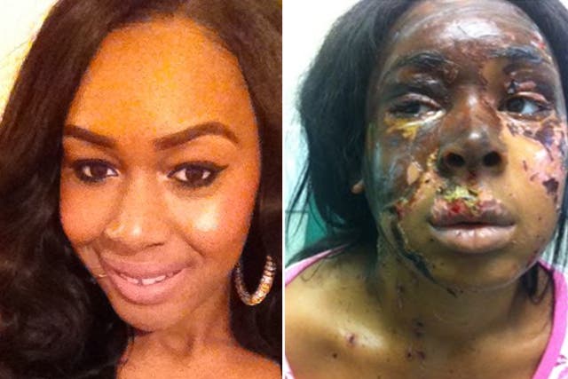 The attack left Naomi Oni with severe facial scarring, right