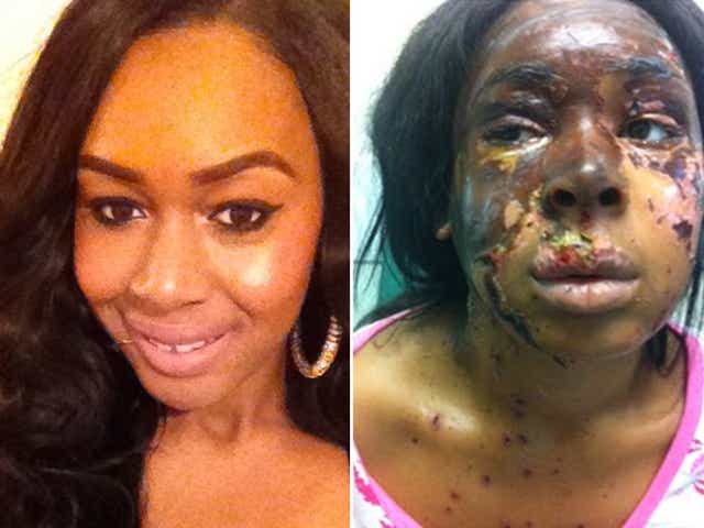 The attack left Naomi Oni with severe facial scarring, right