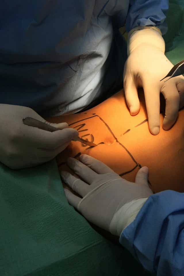 Dark and sad, but not the end: plastic surgery procedure