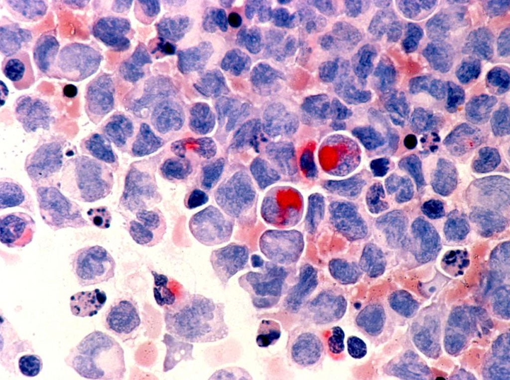 Photomicrograph of human white blood cells with acute myelocytic leukaemia ( AML ) in the pericardial fluid, shown with an esterase stain