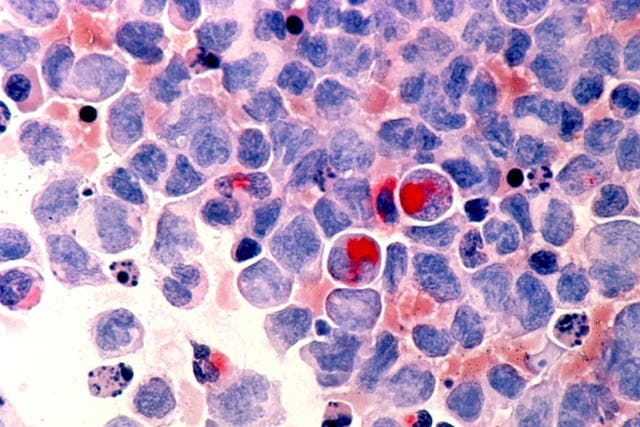 Photomicrograph of human white blood cells with acute myelocytic leukaemia ( AML ) in the pericardial fluid, shown with an esterase stain