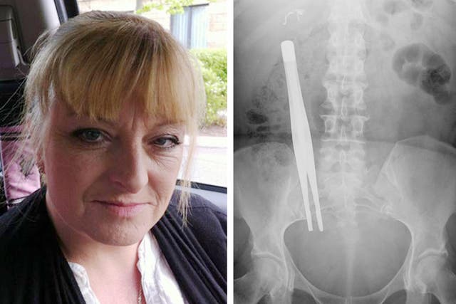 A photograph issued by Irwin Mitchell of the X-Ray showing seven-inch forceps that were left inside Donna Bowett for three months following an operation to remove her gallbladder. The mum of four has joined calls from specialist medical law experts at Irw