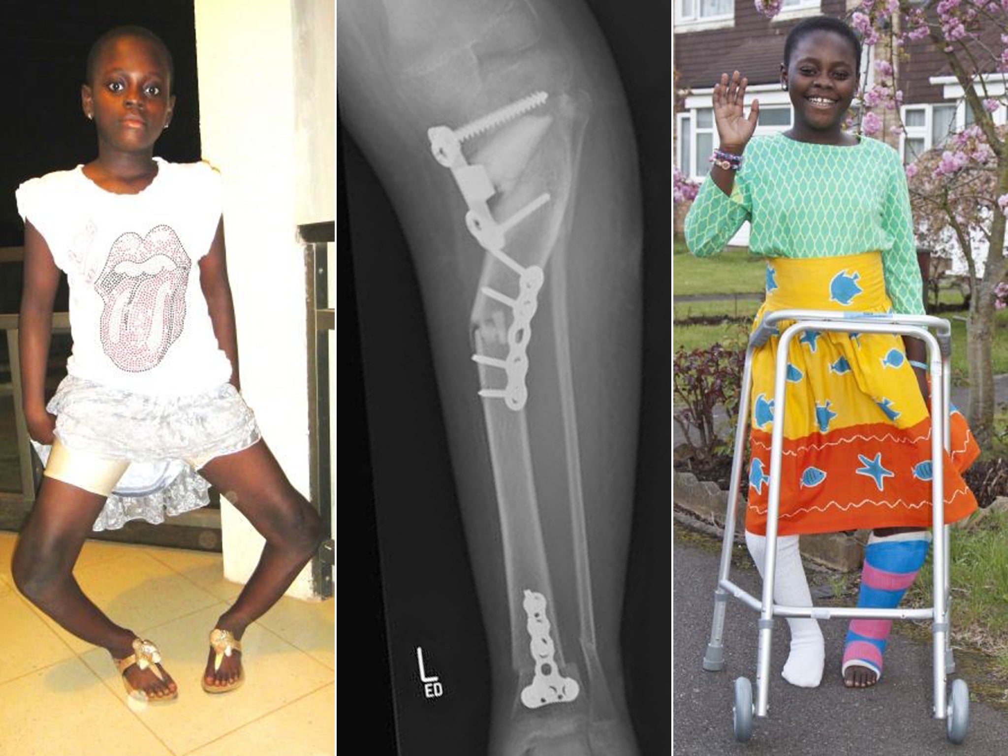Gloria Abeka before (left) and after her leg operations, with an x-ray showing the pins in one her legs
