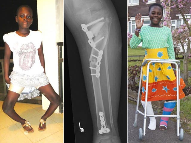 Gloria Abeka before (left) and after her leg operations, with an x-ray showing the pins in one her legs 