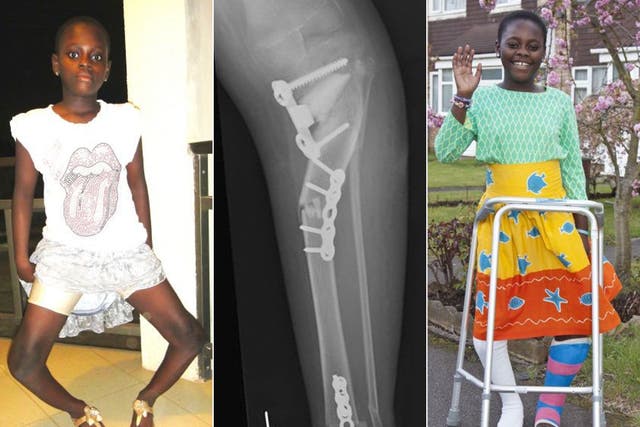 Gloria Abeka before (left) and after her leg operations, with an x-ray showing the pins in one her legs 