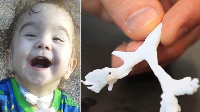 Kaiba Gionfriddo; the tracheal splint produced using a 3D printer
