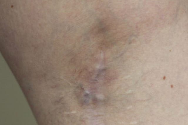 A Melanoma survivor's scar where the mole was removed